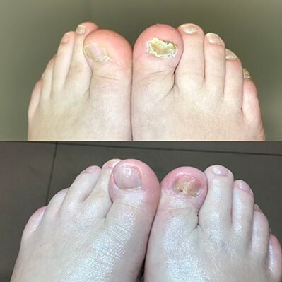 Expérience dans l'utilisation de Crema Barnabas promis par Israël, photos avant et après