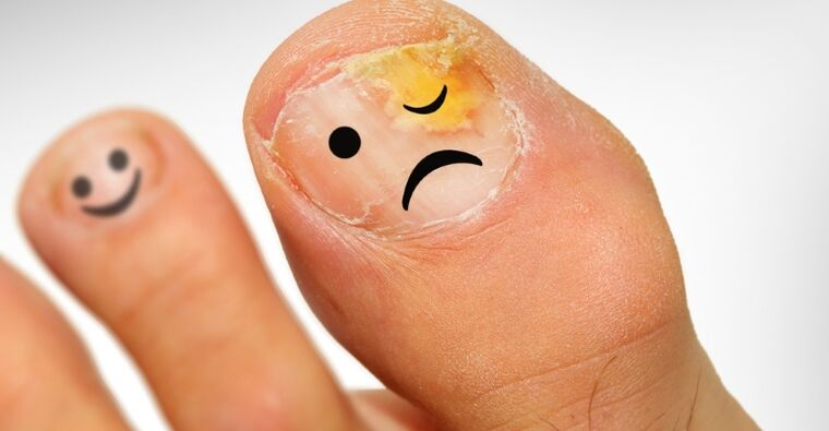 Comment reconnaître le champignon des ongles