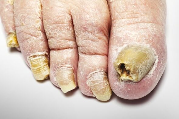 Version totale du champignon des ongles