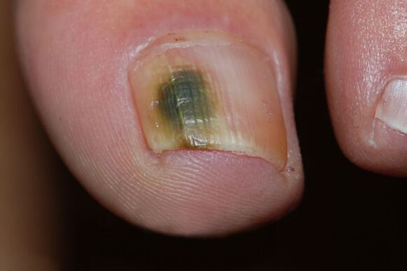 type moisi des champignons à ongles