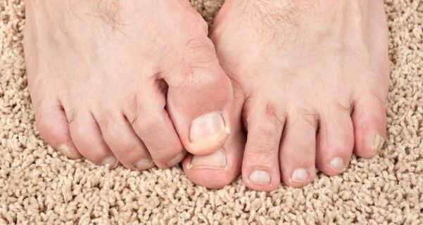 Symptômes des champignons à ongles