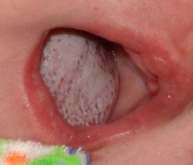 Emplacement de la maladie avec un champignon