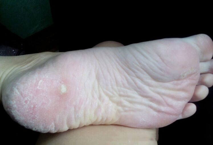 Traitement des champignons avec un laser