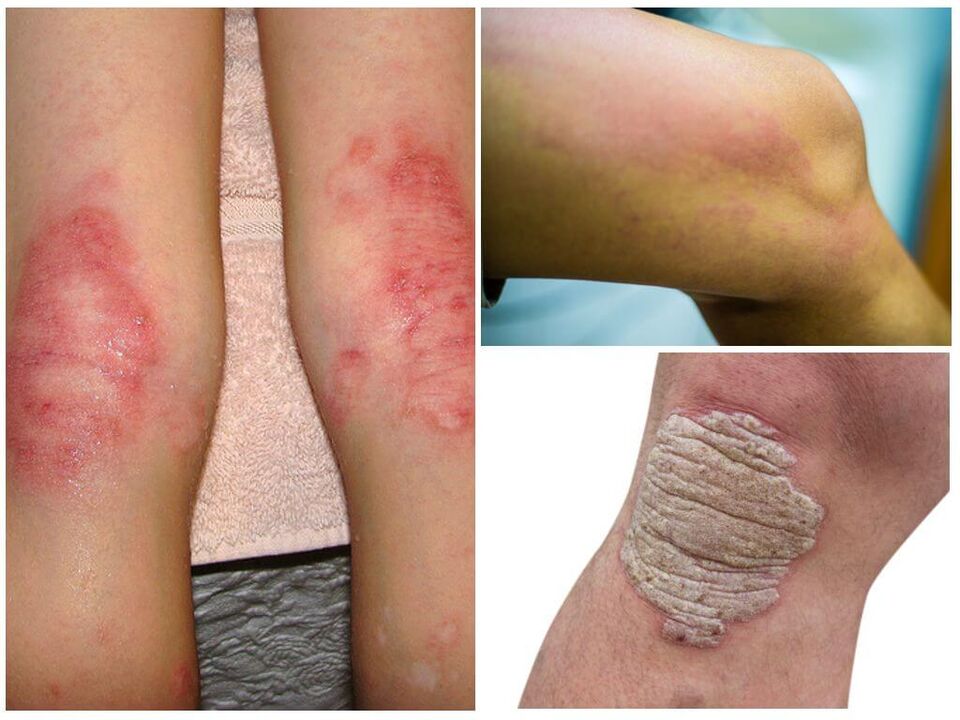 Infections fongiques des genoux