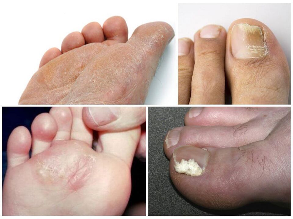 Le stade initial du champignon du pied