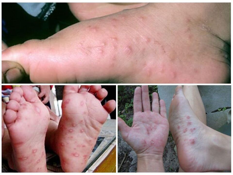 Lésions hyperkératosiques des pieds