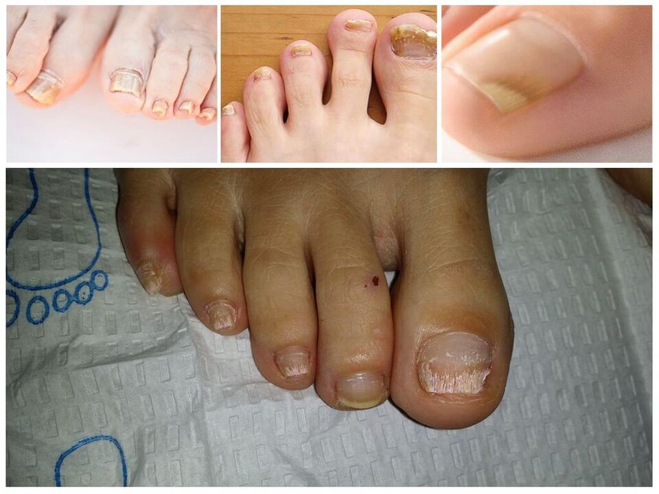 Maladies fongiques des ongles