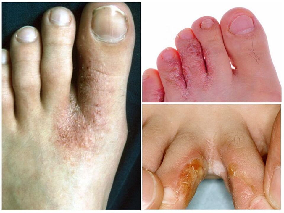 Mycose interdigitale