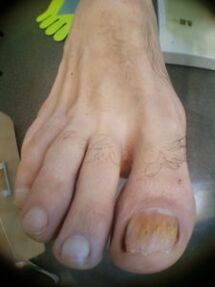 mycose des ongles du gros orteil