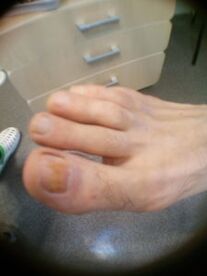 stade précoce de la mycose des ongles des orteils