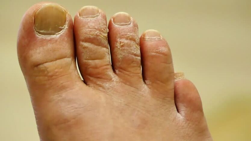 forme squameuse de champignon des ongles des pieds