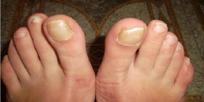 à quoi ressemble la mycose des ongles des pieds