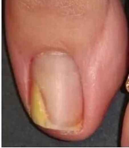 ongle avec champignon avant le traitement