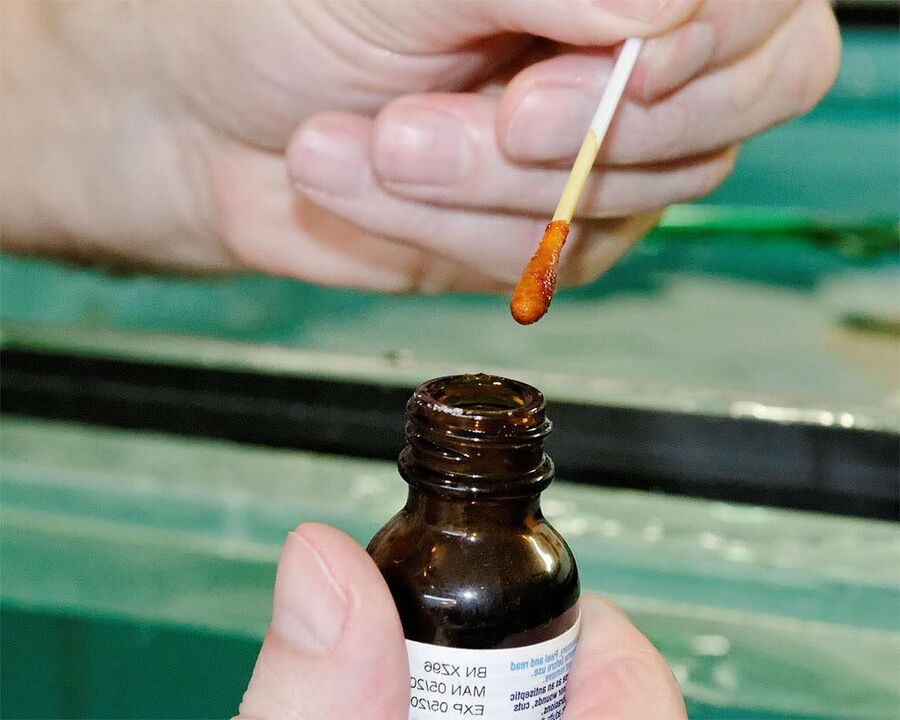 Appliquer un mélange d'iode et de jus de chélidoine sur vos ongles éliminera le champignon