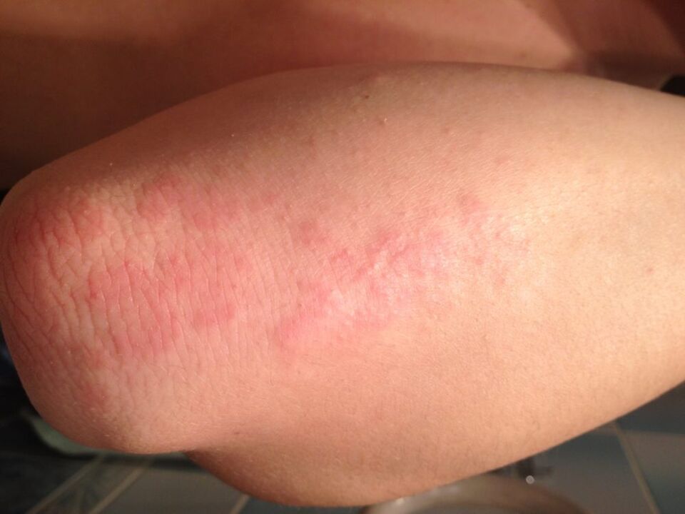 Une réaction allergique sous la forme d'une éruption cutanée sur la peau du coude après l'application d'une goutte de jus de chélidoine